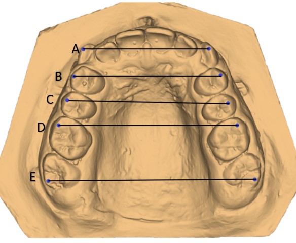 Maxillary arch width; measured the following distances