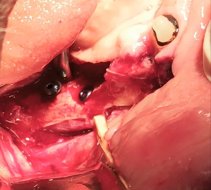 Exposed of IAN canal  