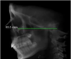 sagittal reconstruction oriented with the Frankfort horizontal (FH) plane parallel to the floor prior to cephalometric analysis