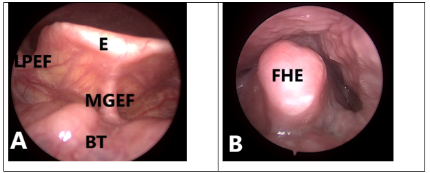 Laryngoscopy at ENT clinic under local anesthesia: A. Normal epiglottis. B. Folded hypertrophic epiglottis.